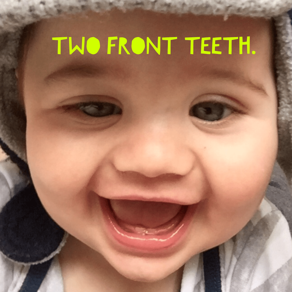 And then there were two (teeth)