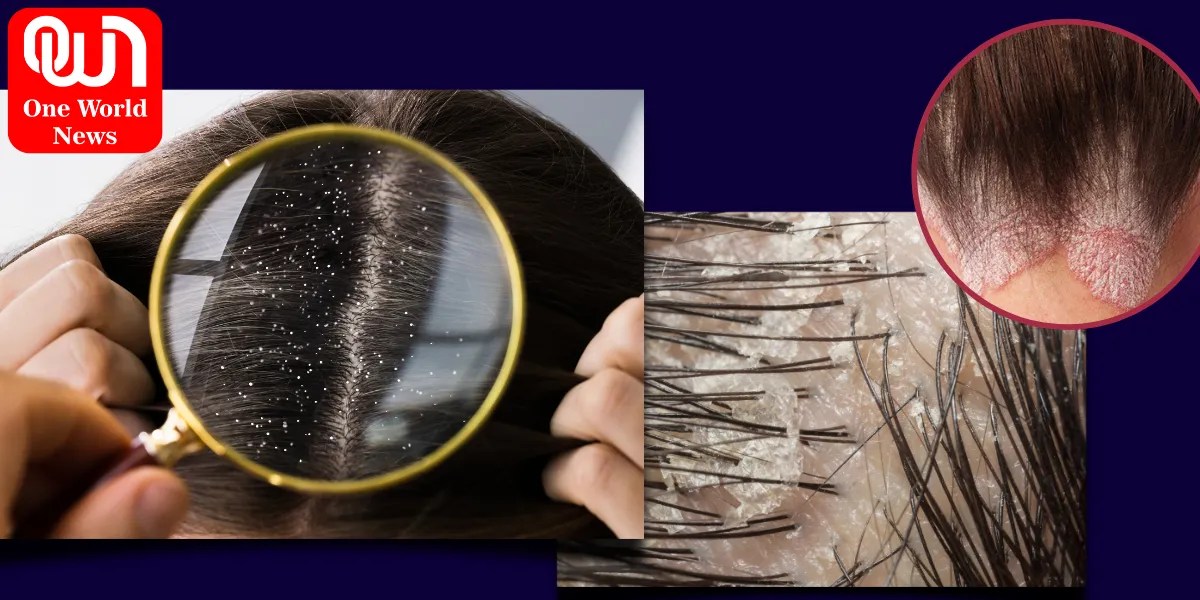 Scalp Conditions Pictures, Causes, and Treatments