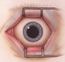 Scheelzien (Strabismus) En Operatie - Oogartsen.nl
