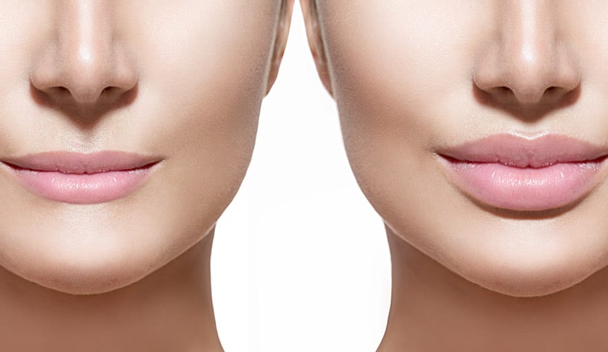 Thin Lips Oo La La Cosmetic & Laser Clinic