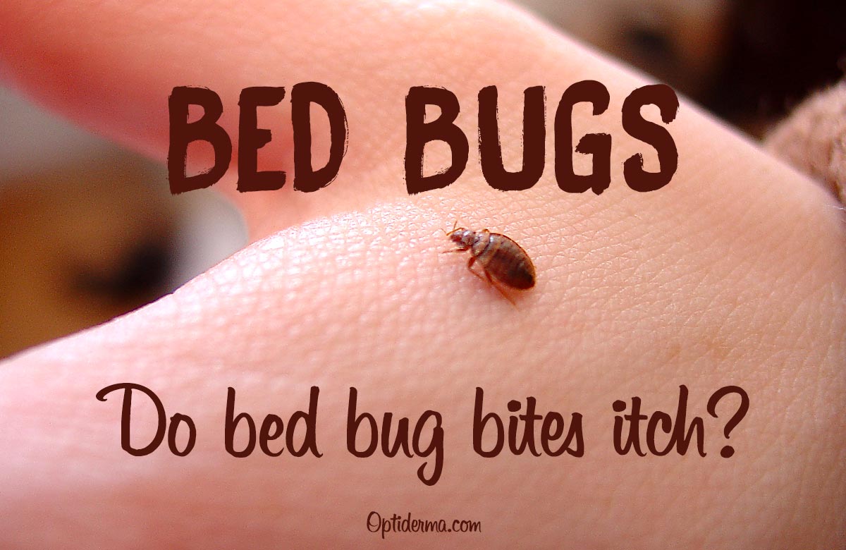Do Bed Bug Bites Itch All Day Long at Joseph Leclair blog