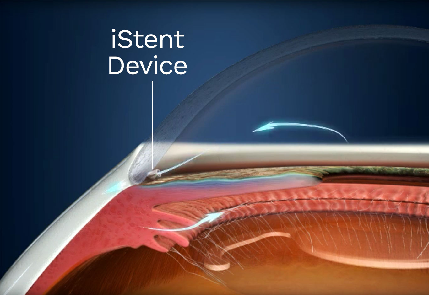 iStent Implant Laser Vision Correction OPTIMAX