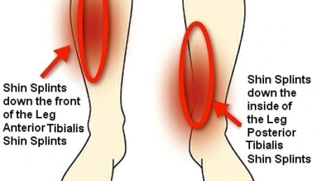 What are shin splints? (Medial tibial stress syndrome (MTSS