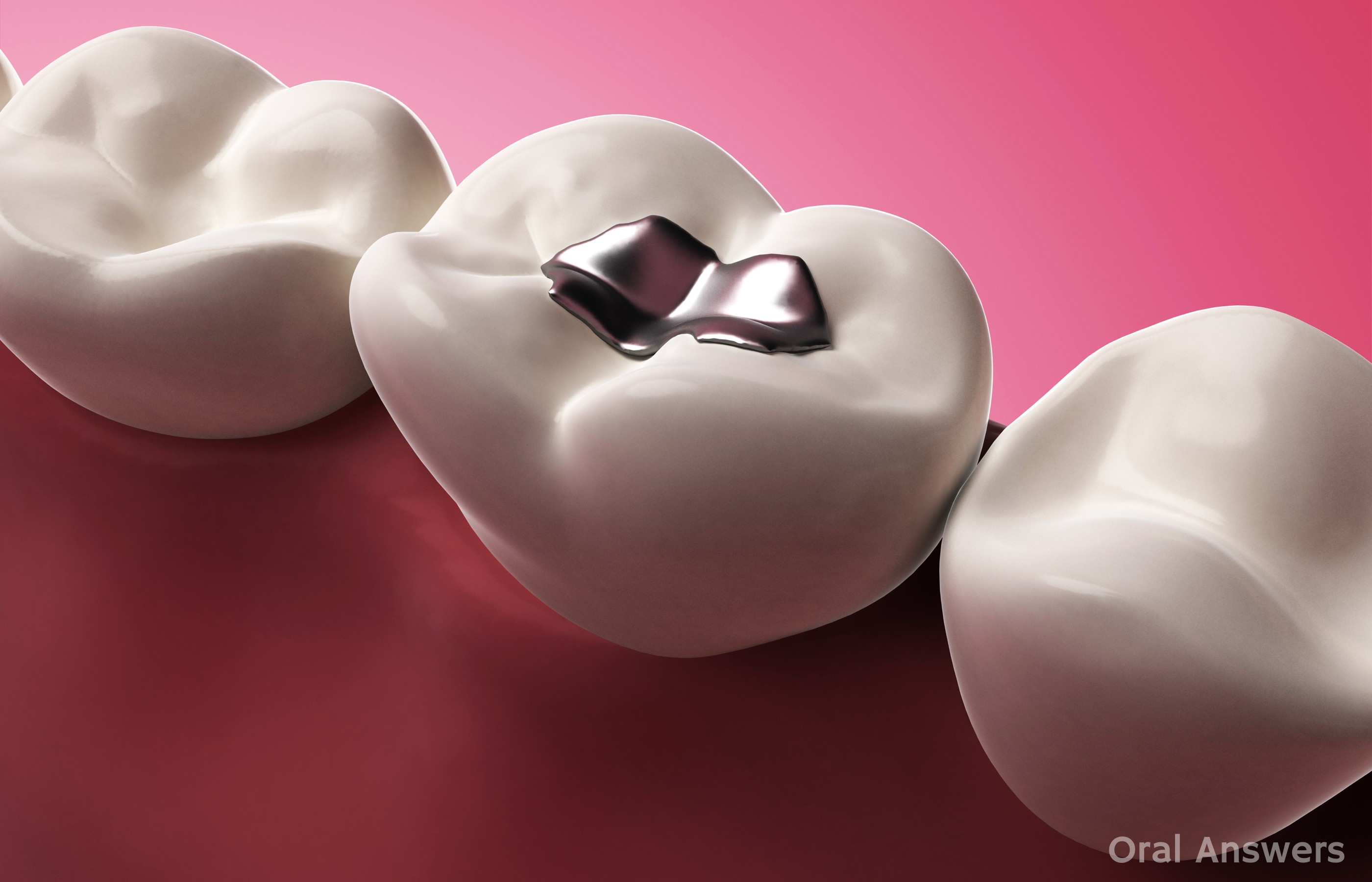 What to Do When You Lose a Filling from Your Tooth Oral Answers