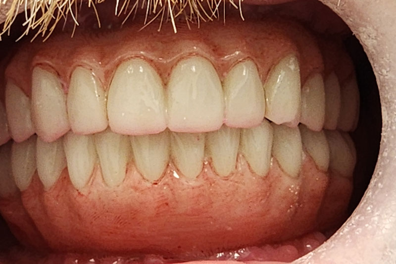 Single & Multiple Dental Implants Flower Mound, TX Denton, TX