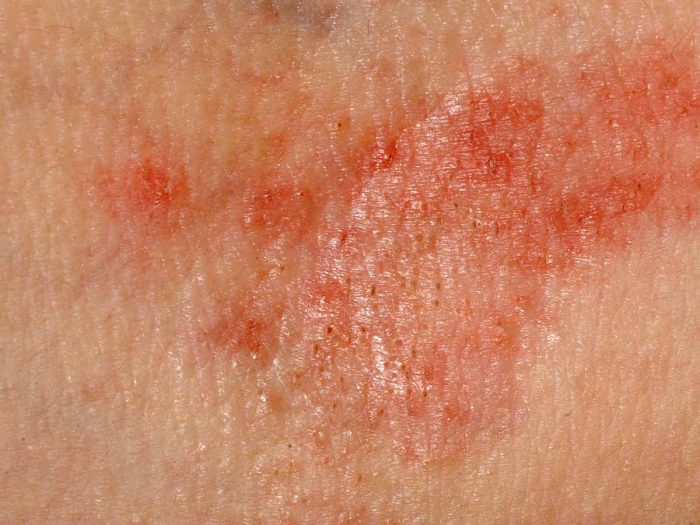 Contact Dermatitis Symptoms, Causes & Treatments ECIG CANADA ZONE