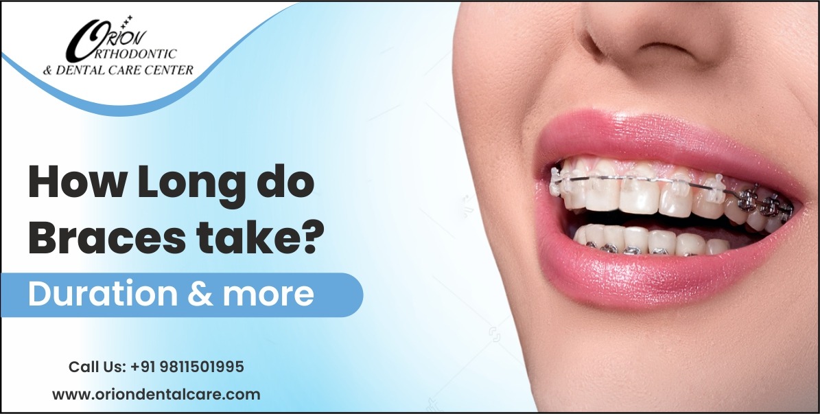 How Long Do Braces take? Duration & More Orion Dental Care