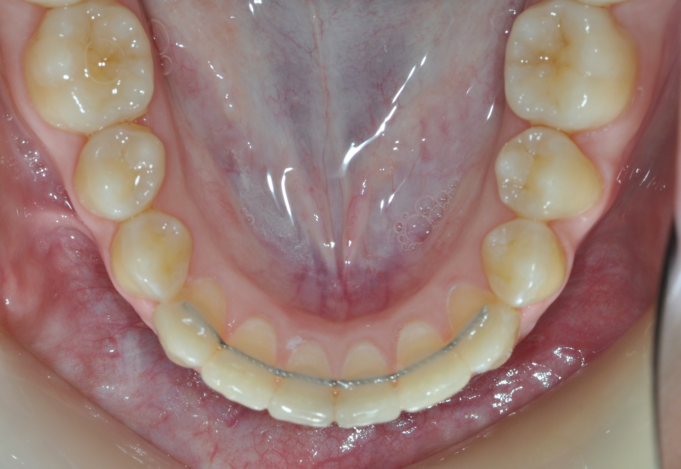Orthodontic Retainers Removable Retainers
