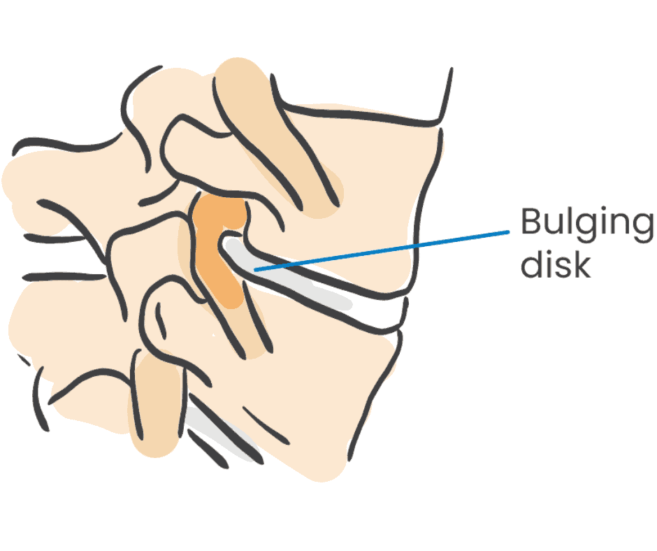 What is a Bulging Disc? Orlando Orthopaedic Center
