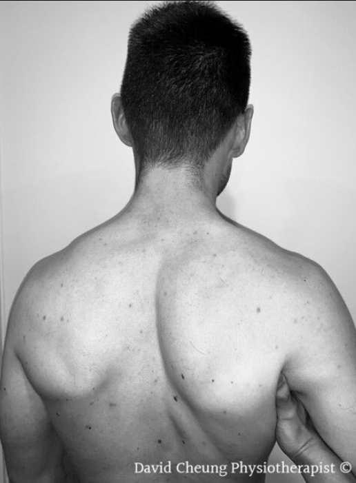 Shrugging Off Your Neck Pain Ormond Physiotherapy