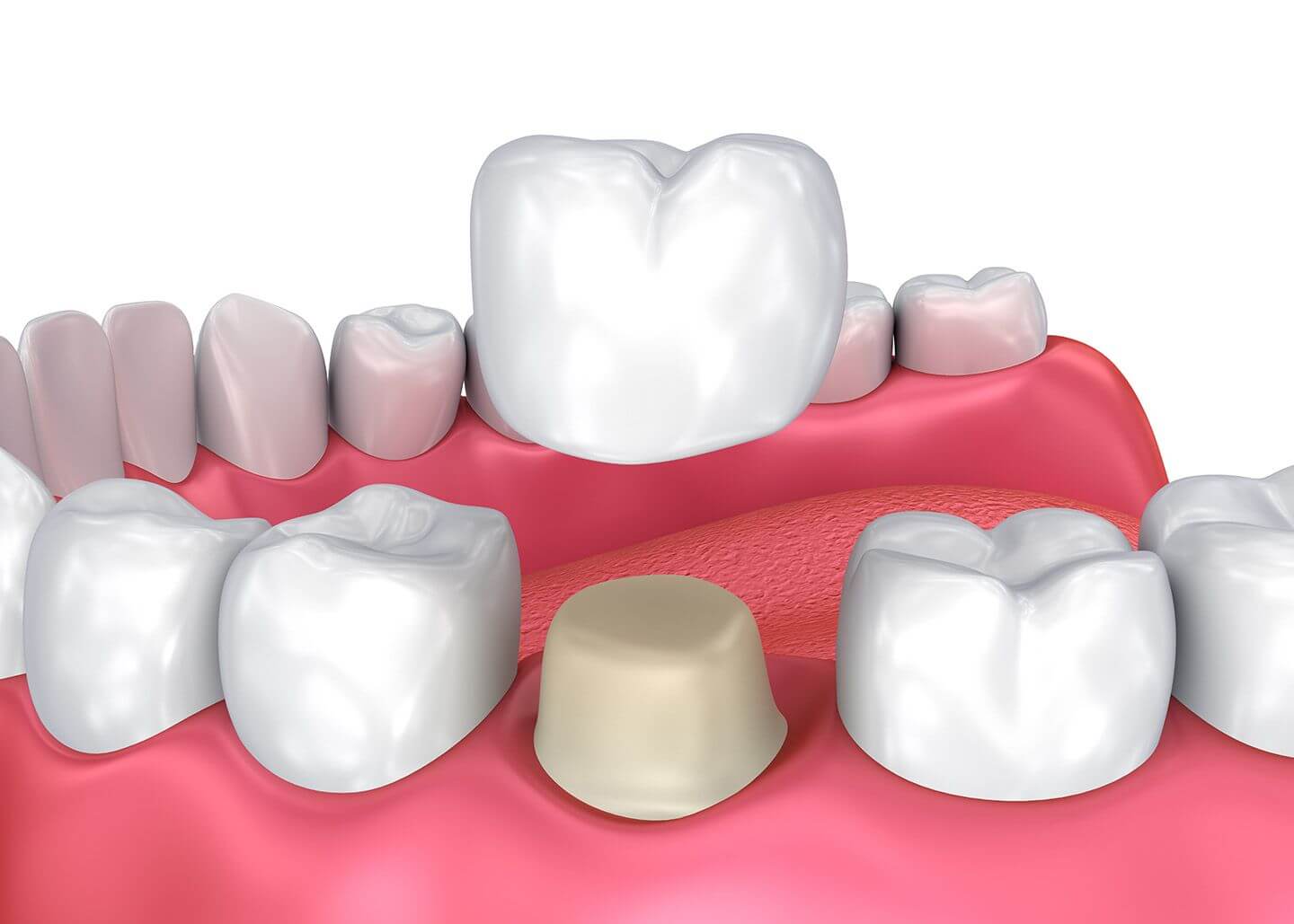 Combined Cost of a Root Canal and Crown Best Dental in Houston, Tx