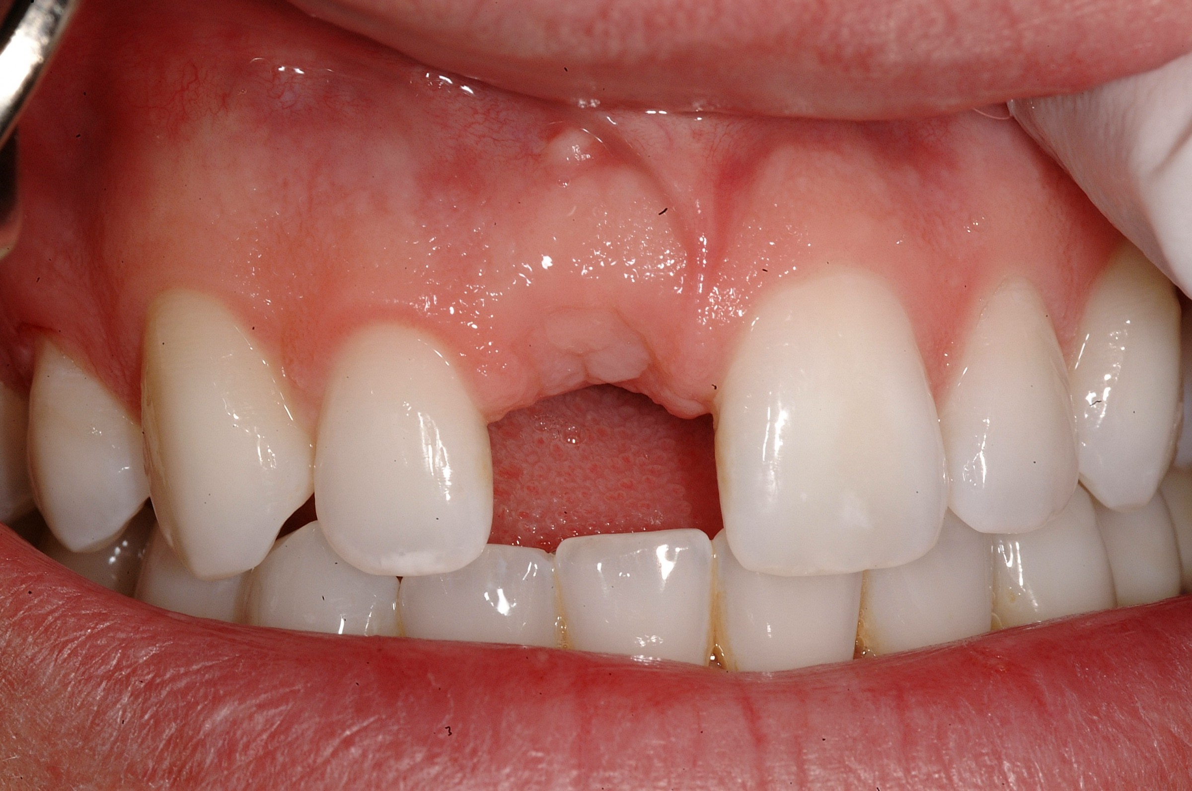 Single Tooth Replacement with Implants Dallas TX, Charles F. Orth, DDS/PA