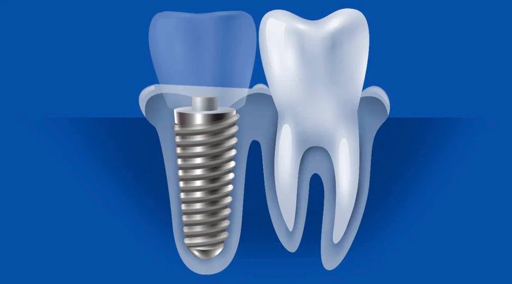 Metalfee Tooth Replacement with Ceramic Implants Dallas TX, Charles F