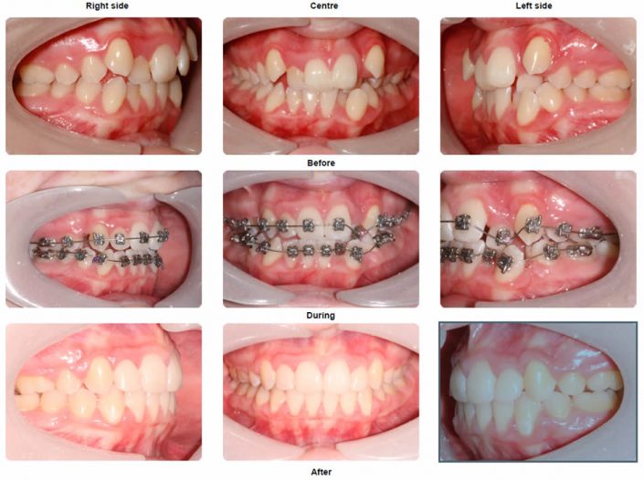 Braces Before and After Photo Gallery orthodontics