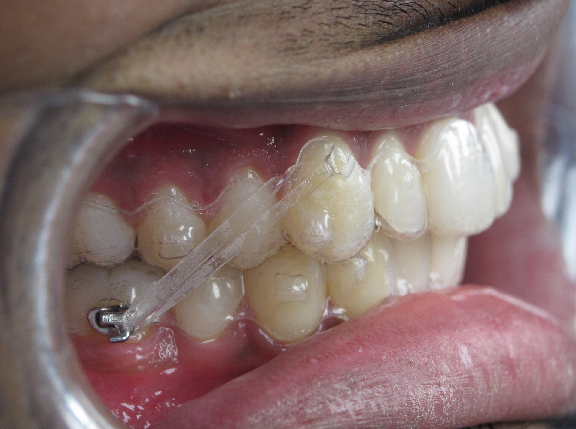 Onzichtbare beugels Orthodontist Hereplein