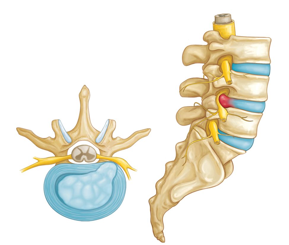 Herniated Disk in the Lower Back OrthoInfo AAOS