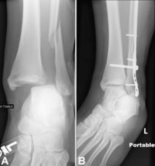 Ankle Fractures (Broken Ankle) OrthoInfo AAOS