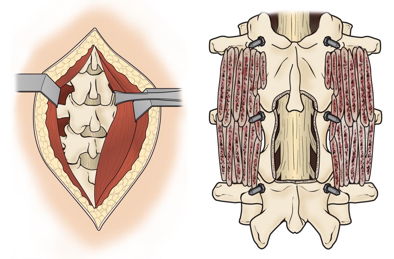 Minimally Invasive Spine Surgery OrthoInfo AAOS