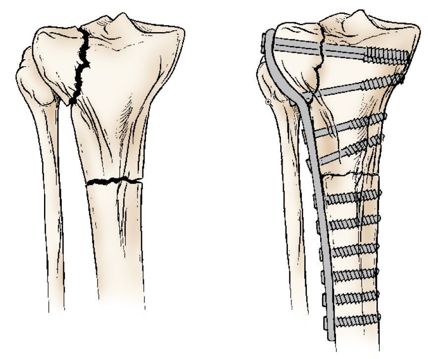 Fractures of the Proximal Tibia (Shinbone) OrthoInfo AAOS