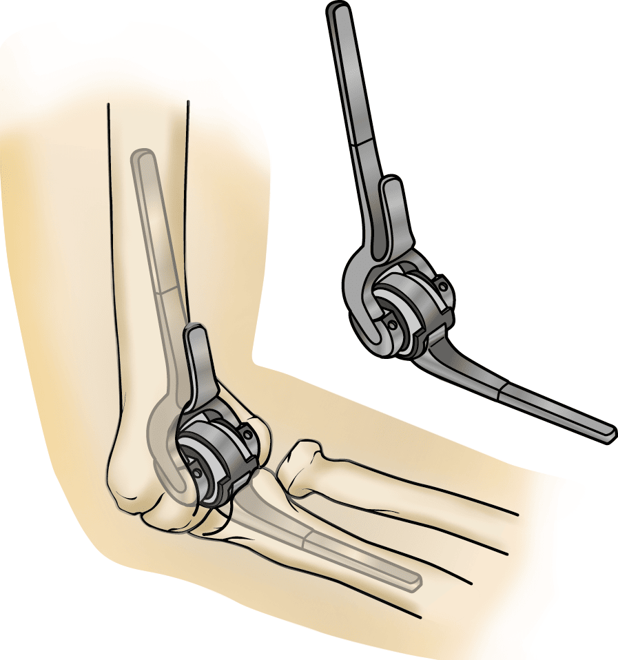 Total Elbow Replacement OrthoInfo AAOS