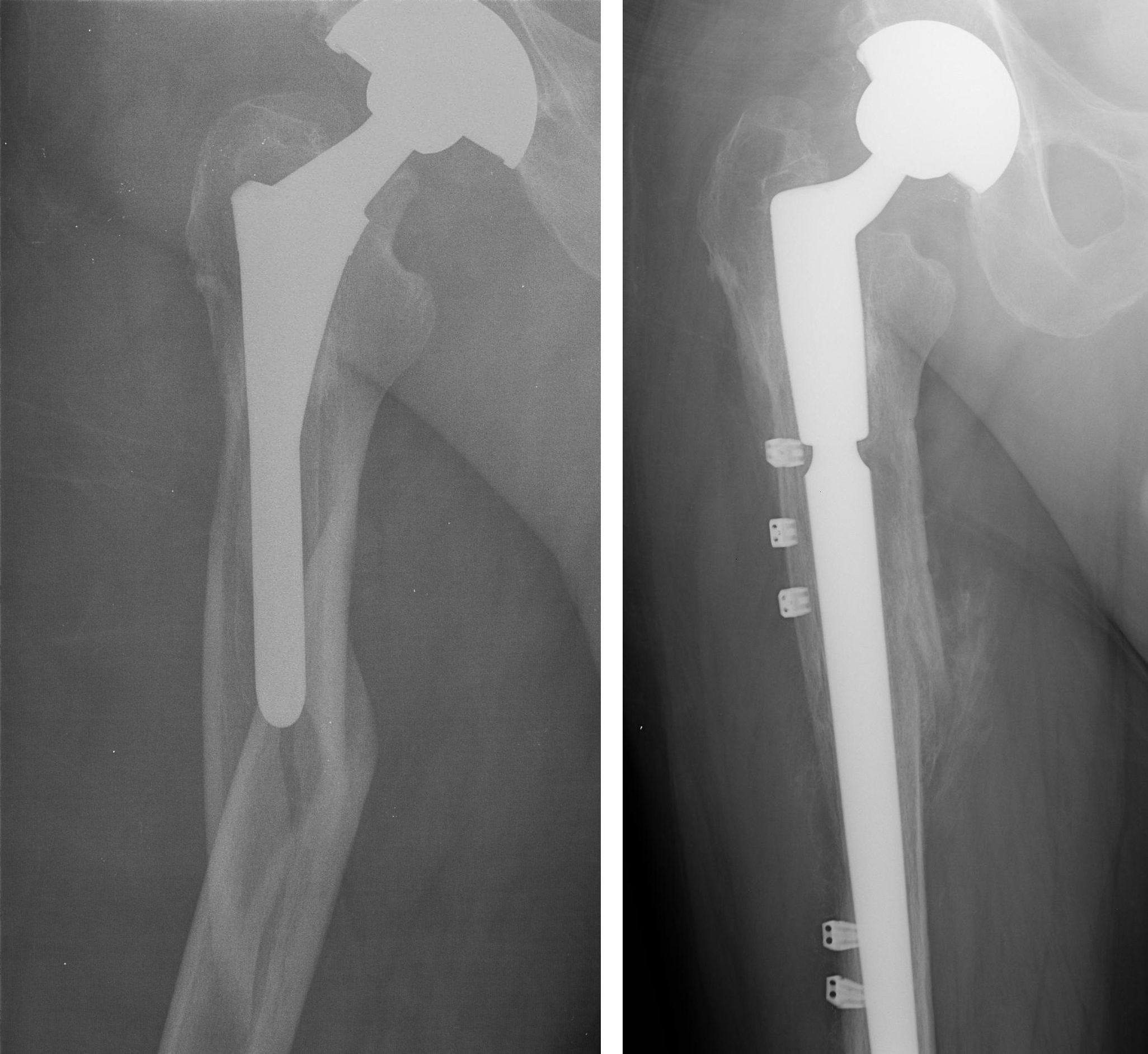 Fracture After Total Hip Replacement OrthoInfo AAOS
