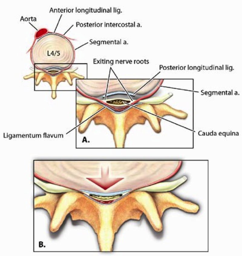 Core Knowledge Cauda Equina Syndrome