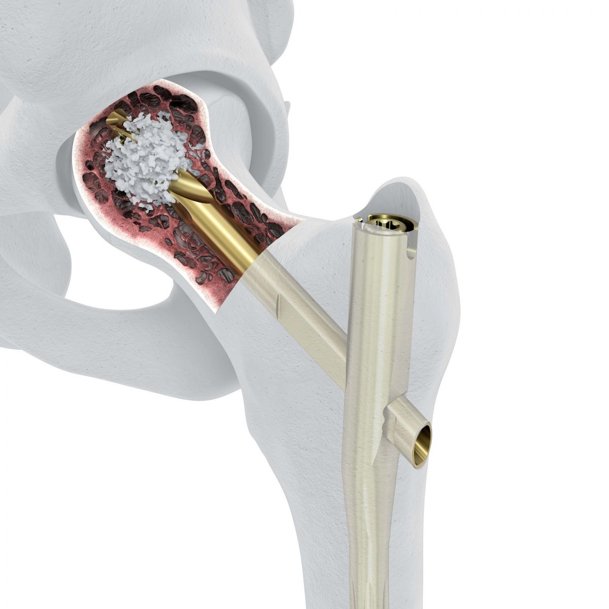 DePuy Synthes Launches TFNA Augmentation System ORTHOWORLD