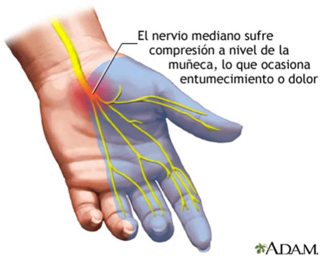 Sindrome del túnel Carpiano causas y tratamiento El blog definitivo