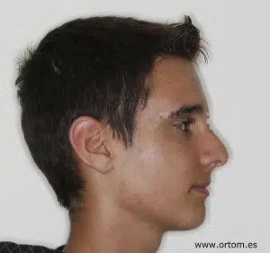Mandíbula pequeña Grupo Ortodoncis Ortodoncia Ortodoncia