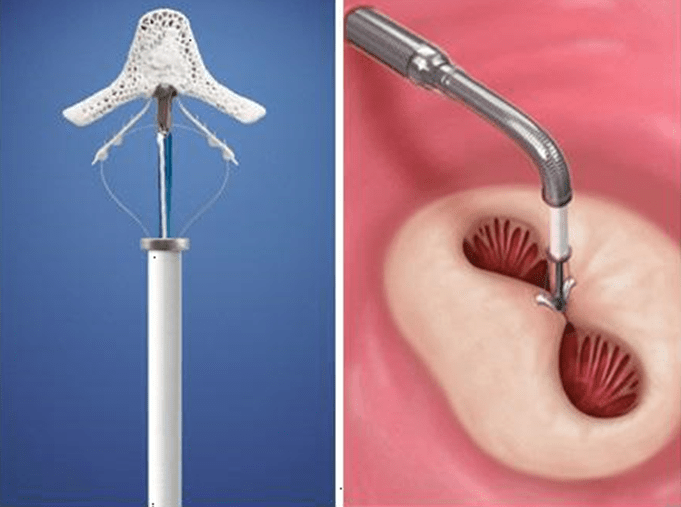 Prof.Dr.Osman Beton MitraClip Therapy Procedure for Mitral Regurgitation