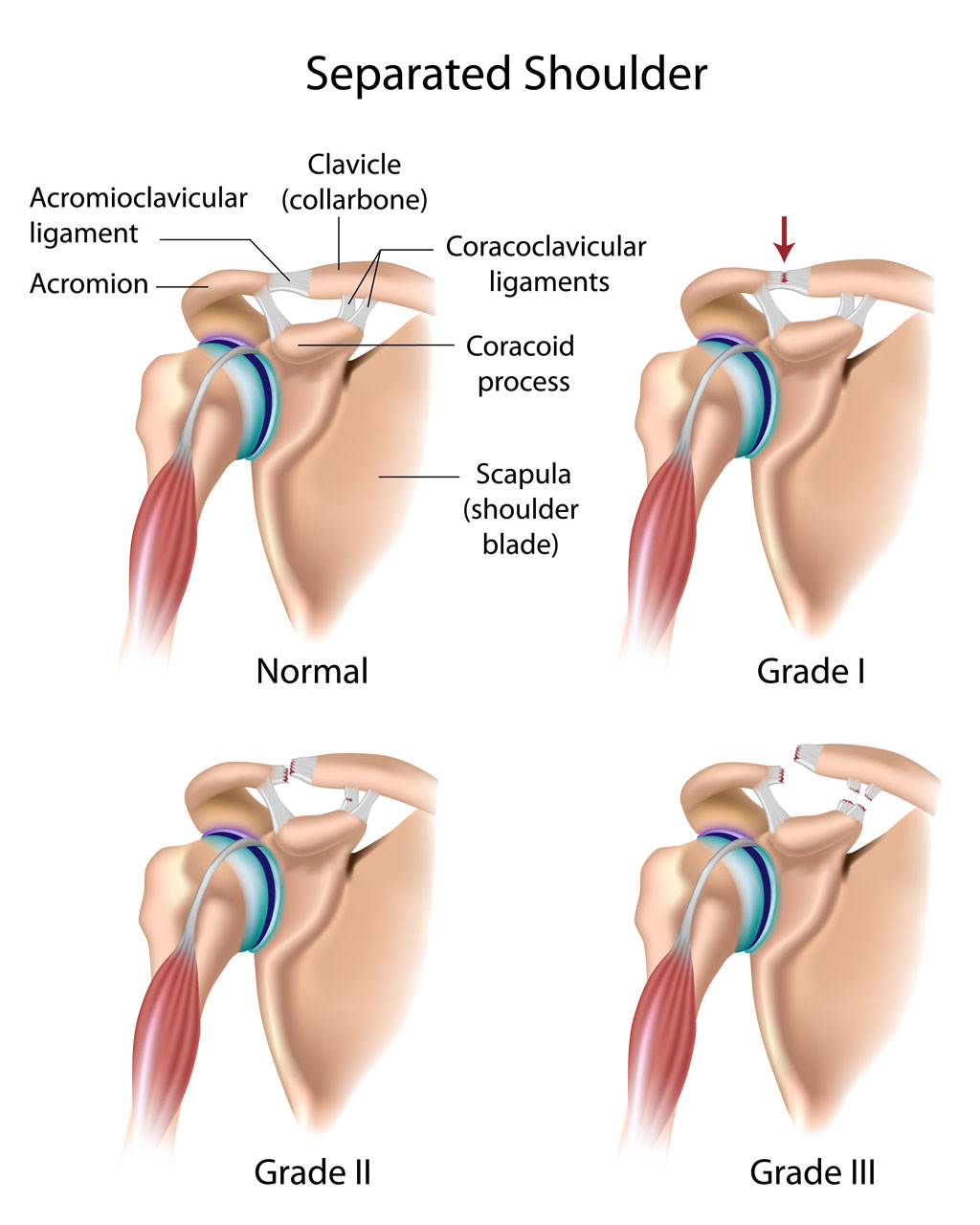 Shoulder Separation (AC Separation) Orthopedic Surgery at OSMI