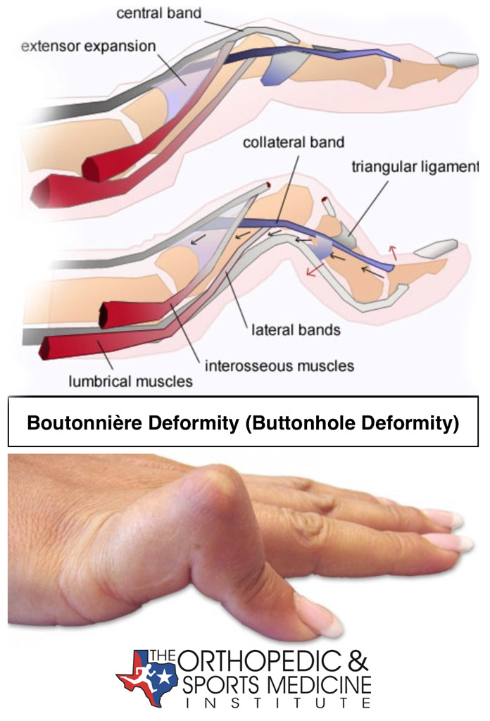 Boutonnière Deformity (Buttonhole Deformity) OSMI Fort Worth