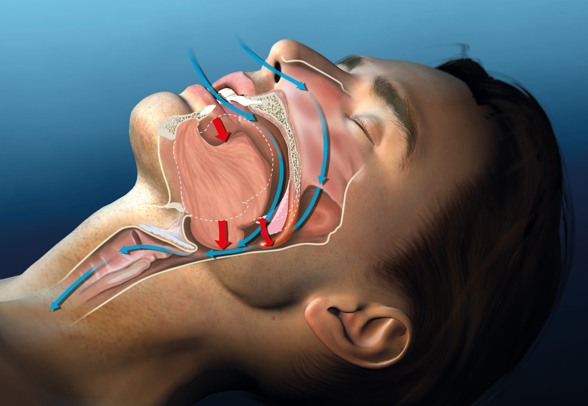 AntiSnoring Devices How to Stop Snoring? North York Dental Clinic