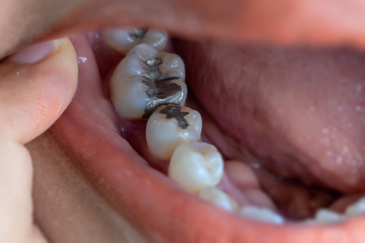 What are the Possible Side Effects of Dental Fillings? North York