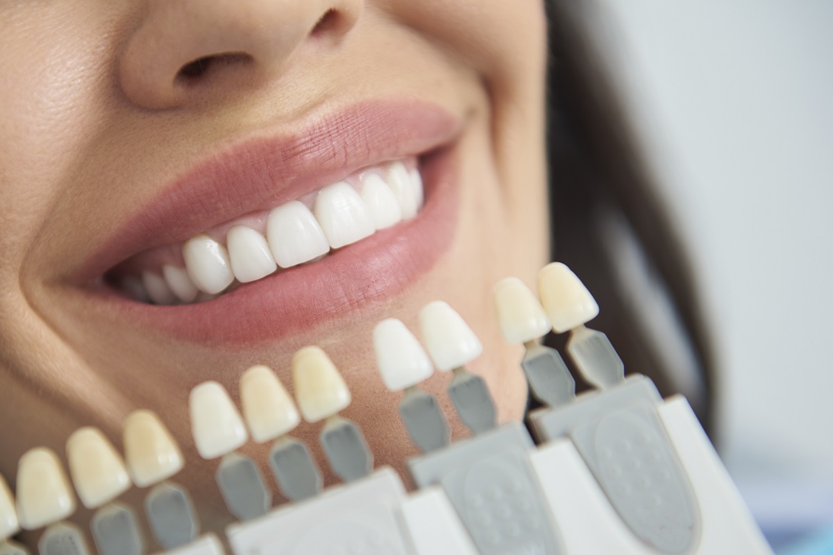 How Much Does Teeth Whitening Cost in Canada? North York Dental Clinic