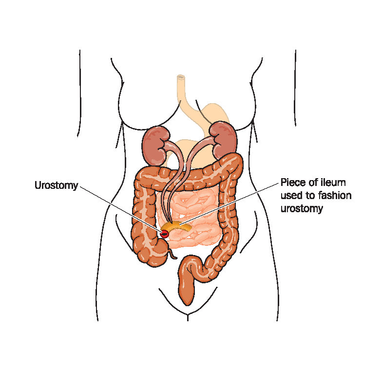 Urostomy Information l United Ostomy Associations of America