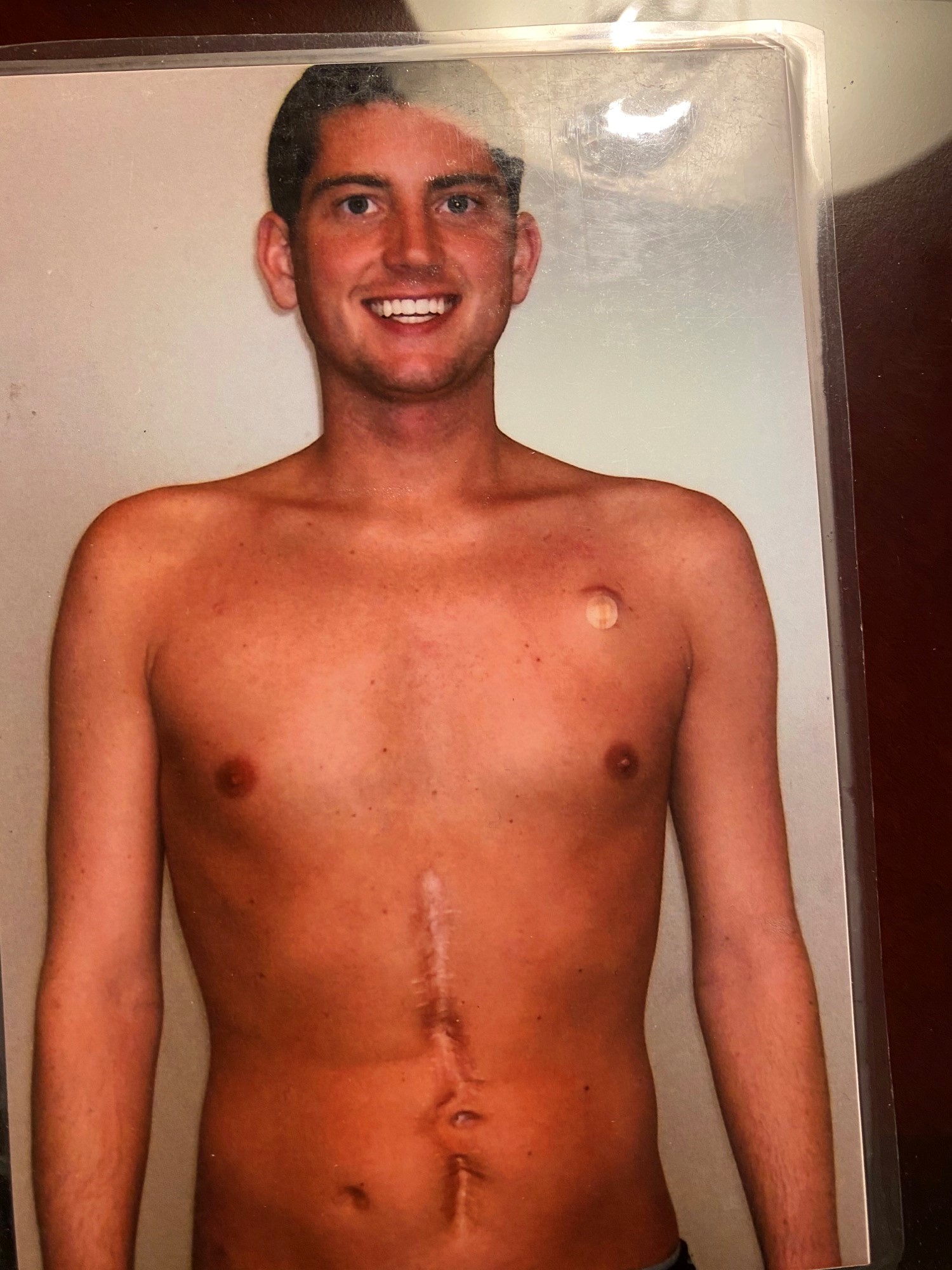 ostomy reversals Archives United Ostomy Associations of America