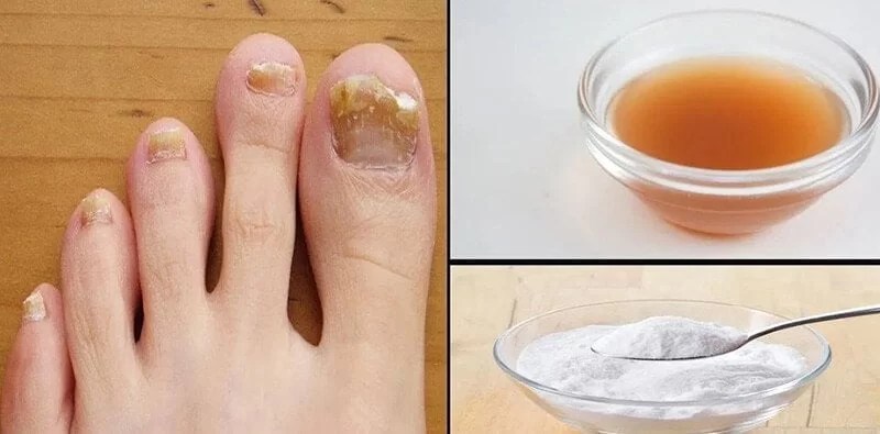 How To Use Apple Cider Vinegar For Toenail Fungus? Ostomy Lifestyle