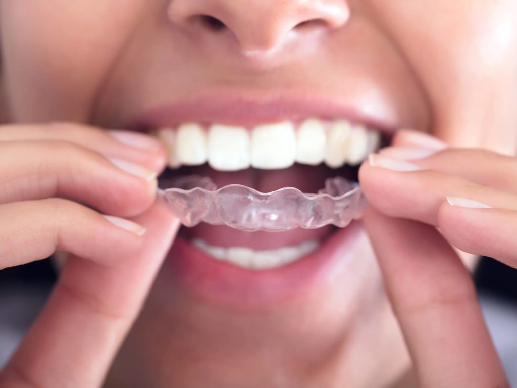 Boost Your Child's Confidence and Development with Invisalign