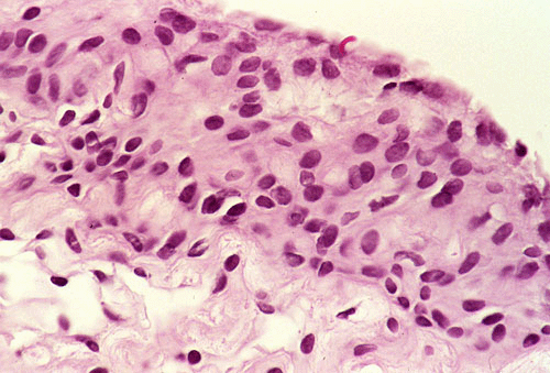 Pathology Outlines Arachnoid cyst