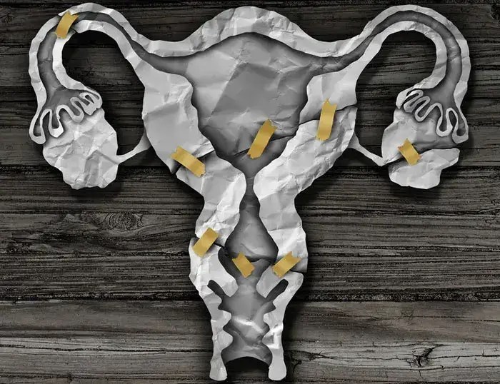 Coding Vaginal Hysterectomy Be Familiar with the CPT Codes