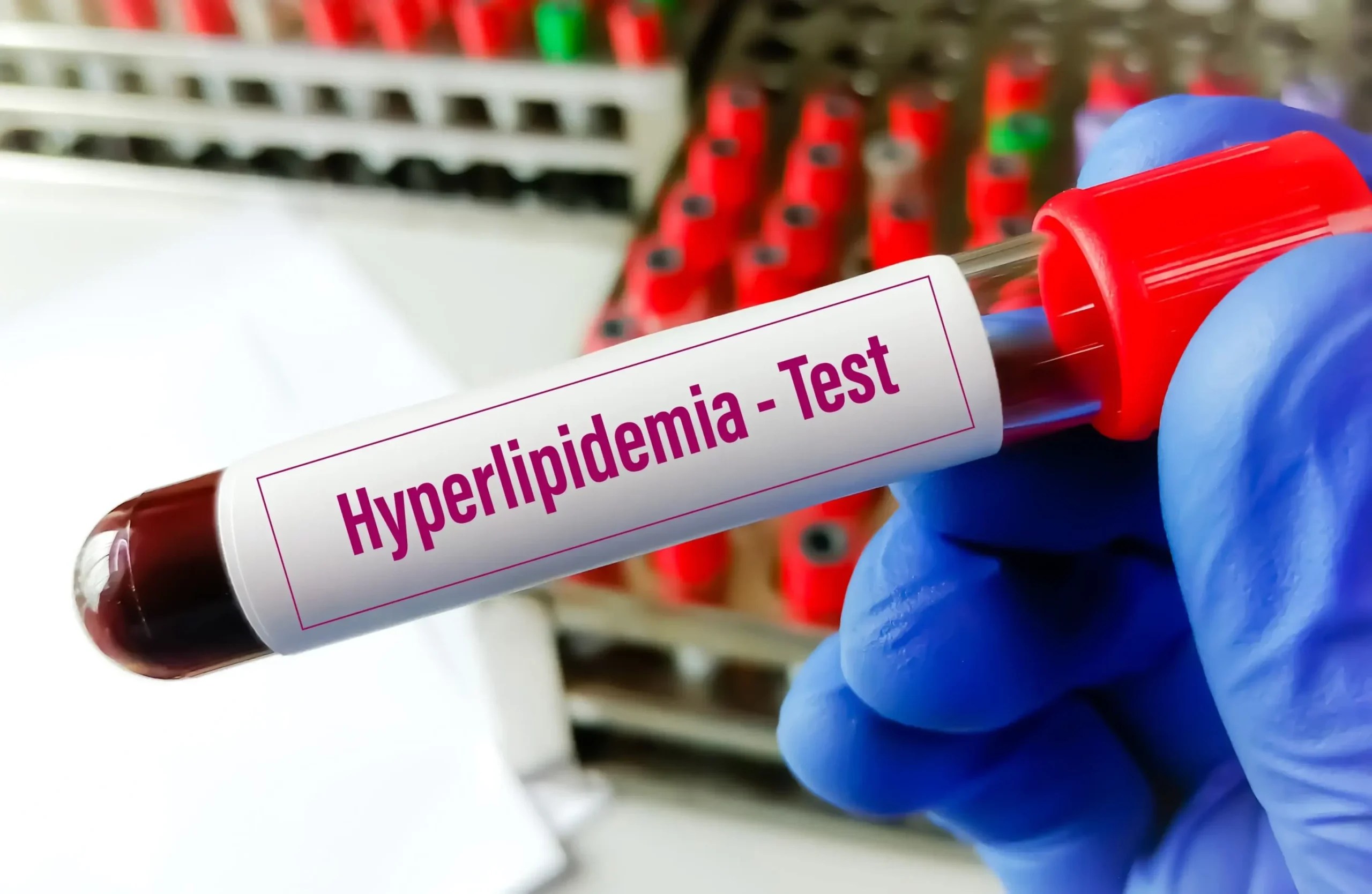 ICD-10 Codes for Hyperlipidemia