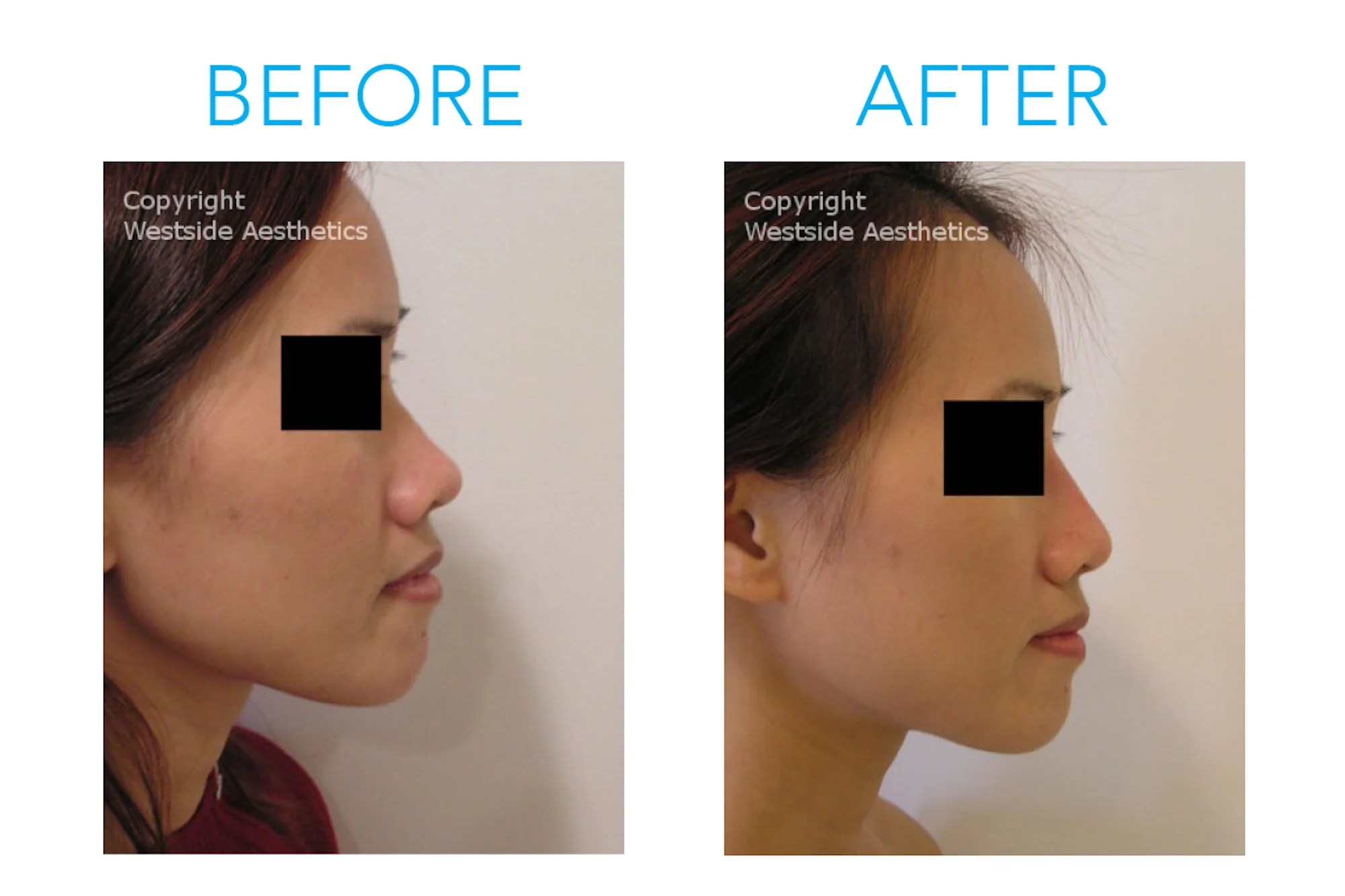 The NonSurgical Nose Job