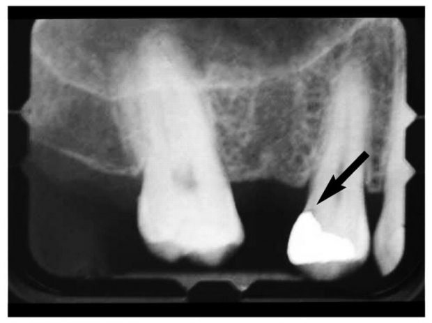 Failure of Amalgam Restoration Recurrent Caries
