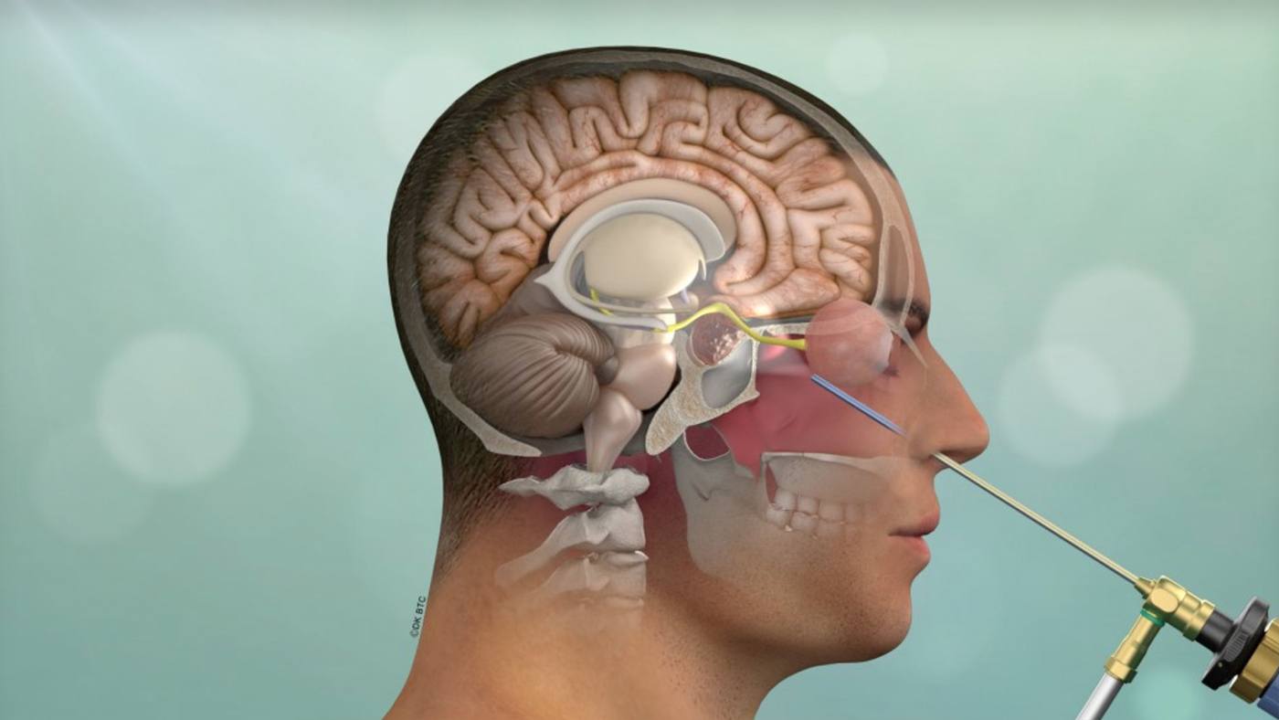 Minimally Invasive Brain Surgery Keyhole Craniotomy Pacific Brain Tumor Center