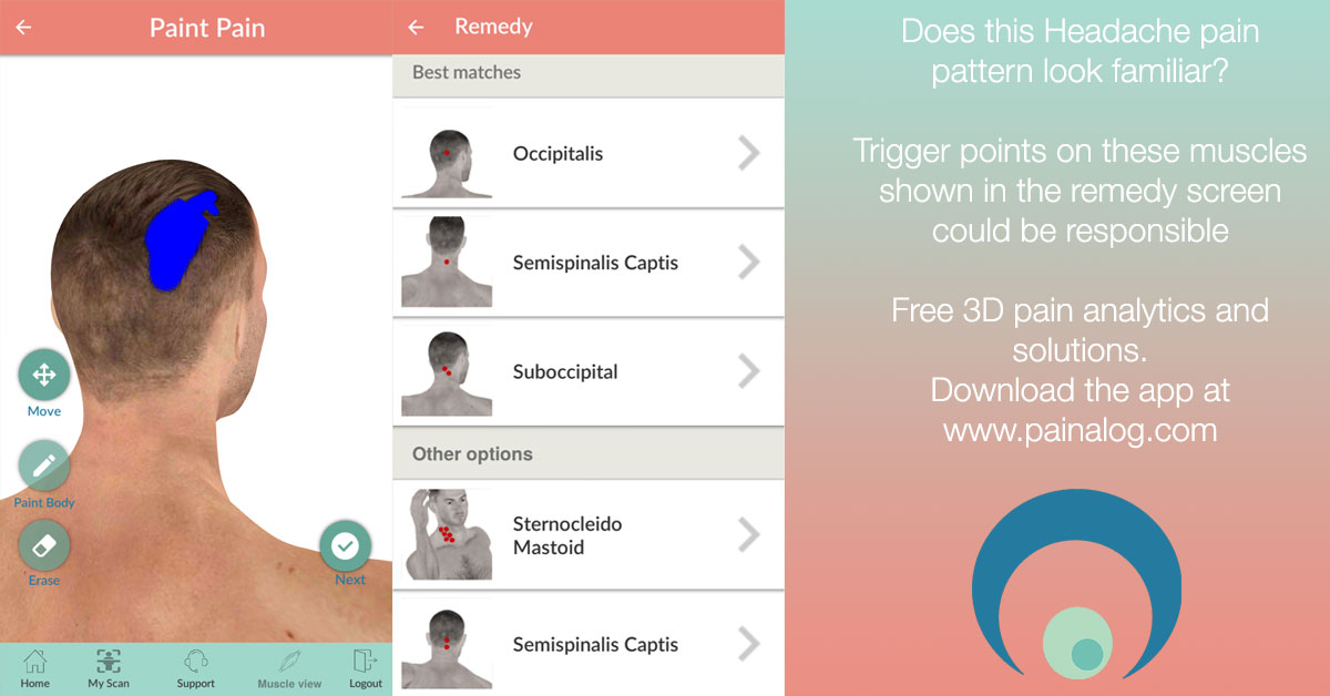 Back of the head pain My discovery using the Painalog app