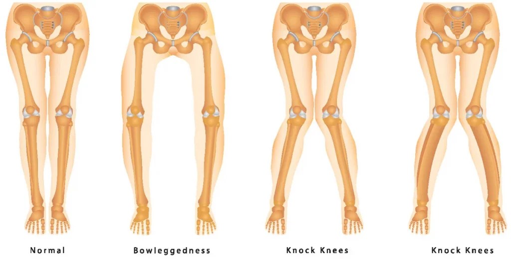 Knock Knees Causes, Treatment and Best Exercises 2023