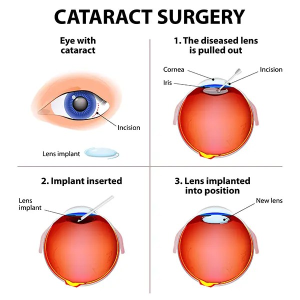 Cataract Removal Surgery Stitches