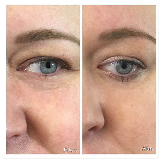 PDO Thread Lift Before & After Photos Parfaire Medical Aesthetics