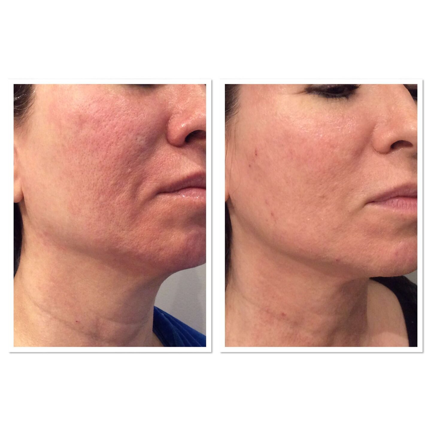 Acne Scar Before & After Treatment Parfaire Medical Aesthetics Pasadena